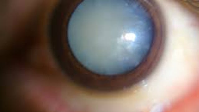 Cataract
